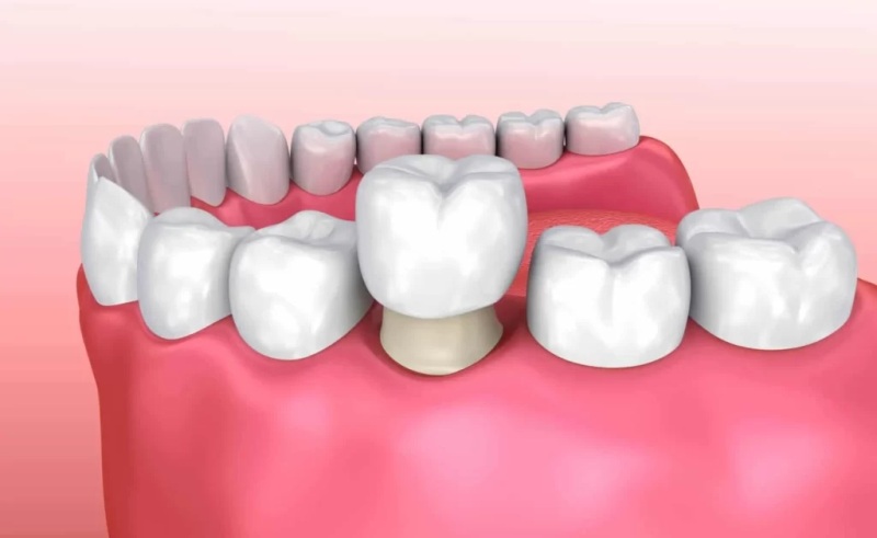 dental crowns - soothing care dental - rozelle