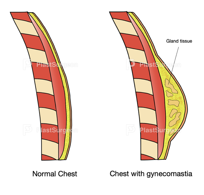 This image has an empty alt attribute; its file name is Gynecomastia1.png