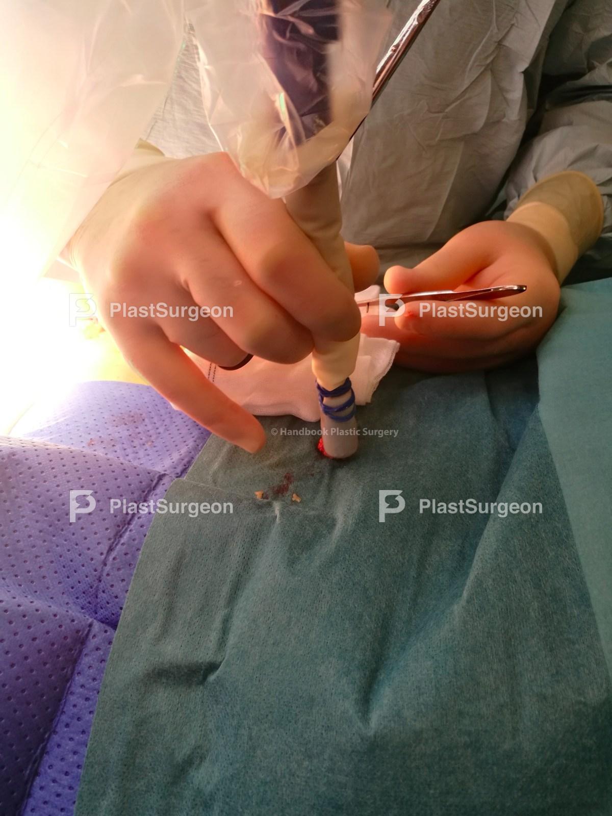 Sentinel node · PlastSurgeon