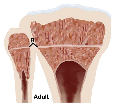 Figure 2. Closed Growth Plates “B”