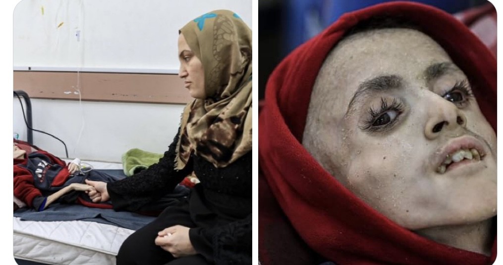 الطفل في الصورة بالفعل يعاني من شلل دماغي لكن سوء التغذية وعدم توفر العلاج أوصله لهذا الحال.