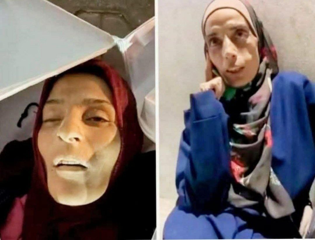السيدة سلوى الغزية التي هزت العالم بنحول جسدها على قيد الحياة