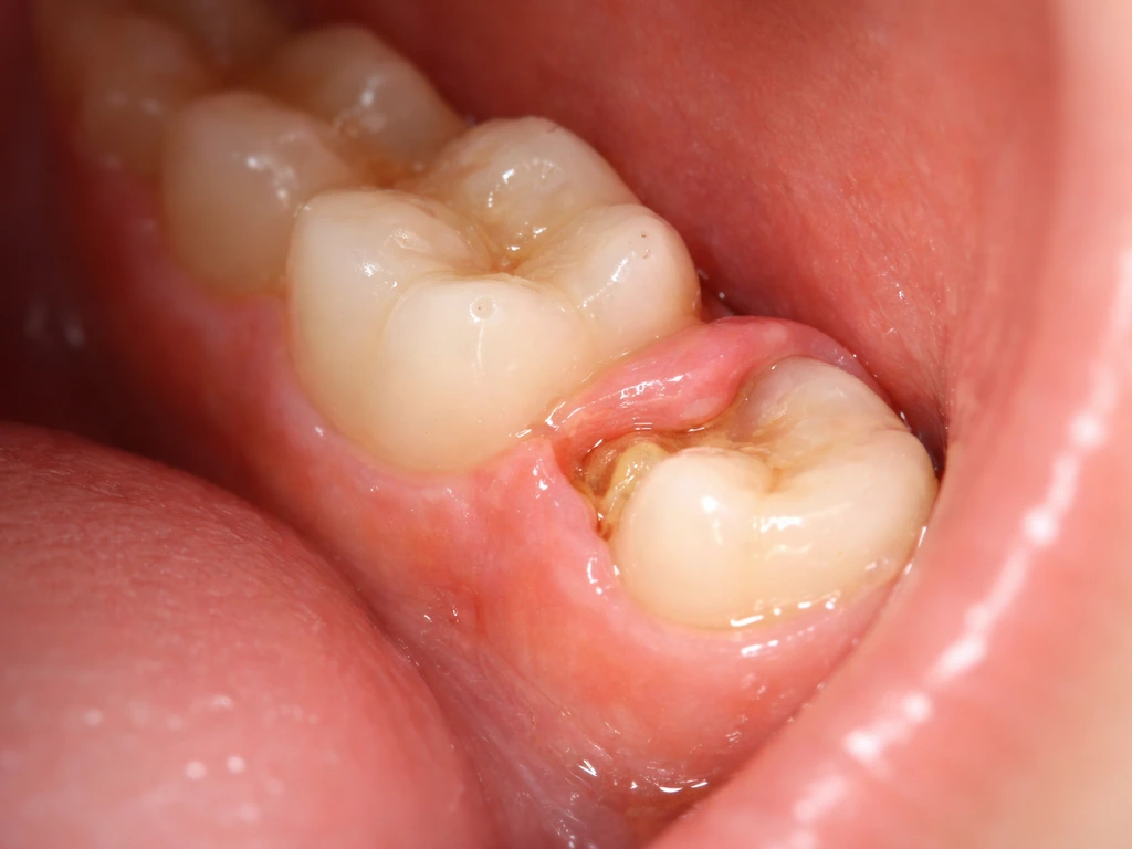Close-up of irritated back lower gum near a partially erupted wisdom tooth with mild swelling