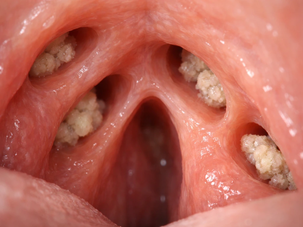 Realistic photo of tonsil crypts with small debris buildup in folds, minimal medical macro scene.