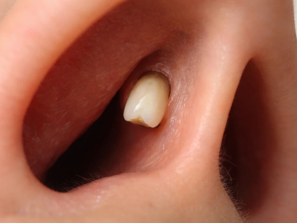 A single white tooth protruding toward the nasal cavity area, shown with subtle anatomical surroundings.