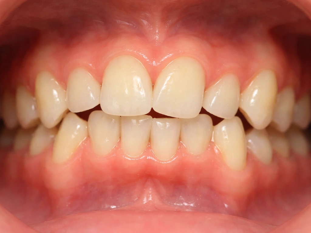 why do teeth grow in crooked