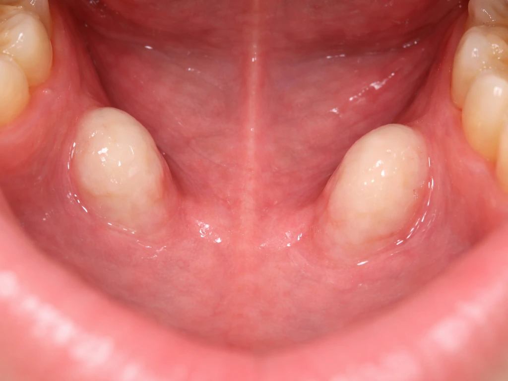 Close-up view of the tongue-facing lower jaw area with two small benign bony bumps in a minimal oral scene.