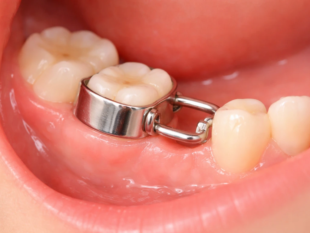 Close-up of a child’s molars with a dental space maintainer holding the gap after a missing tooth.