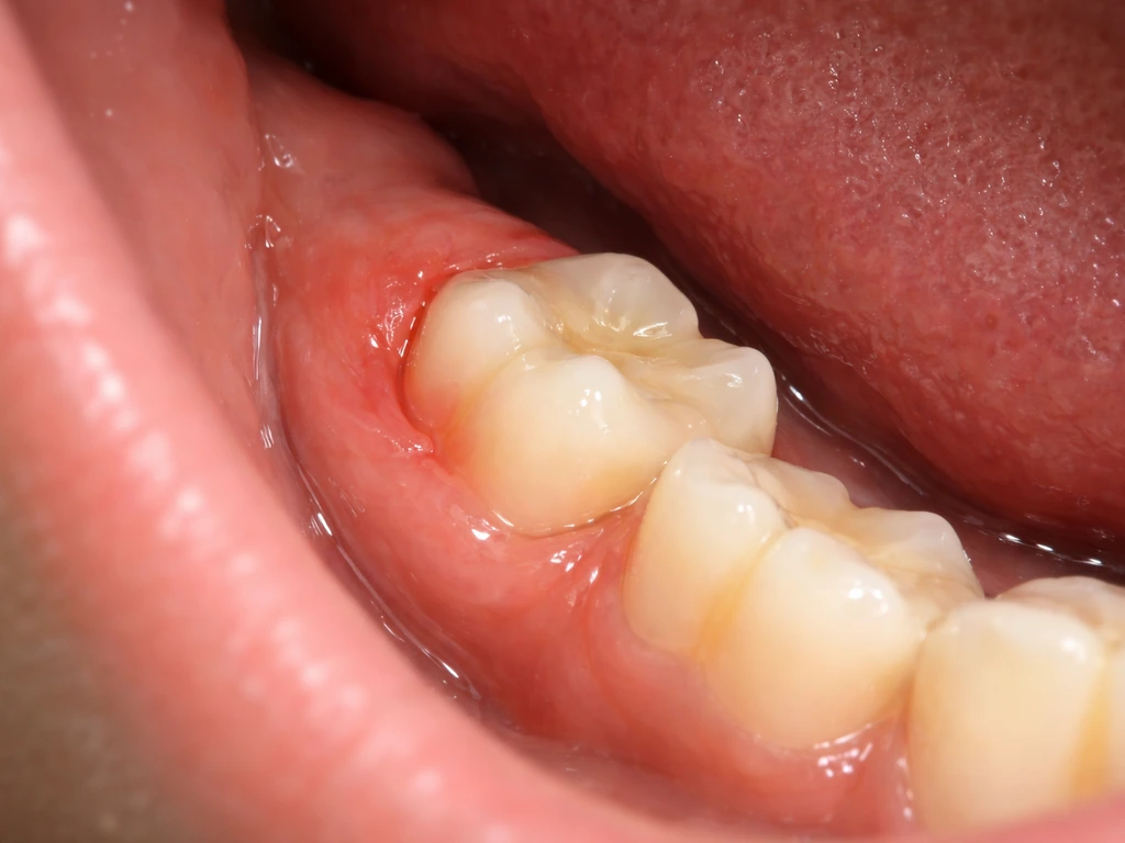 Close-up of partially erupted wisdom tooth area at the back of the lower jaw