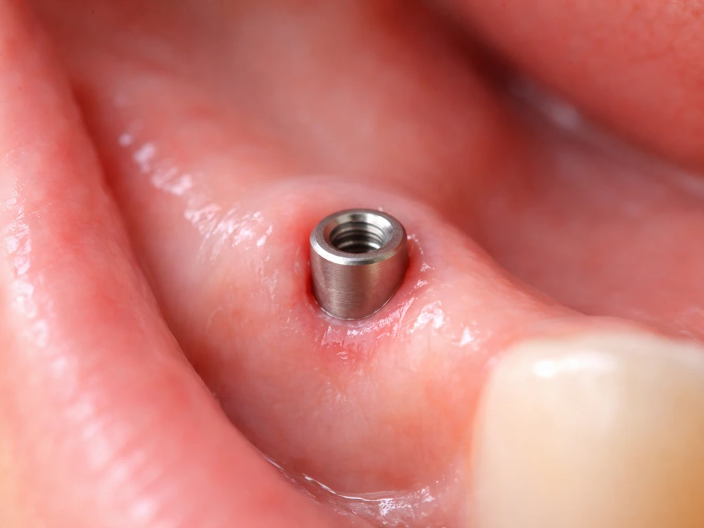 Does Gum Grow Around Implant? What to Expect and Fix
