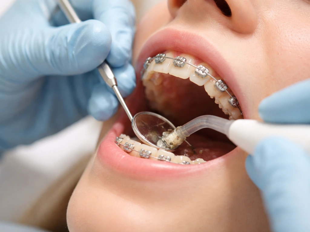 Gloved dental hygienist cleaning tartar around braces with mirror and suction in a bright operatory.