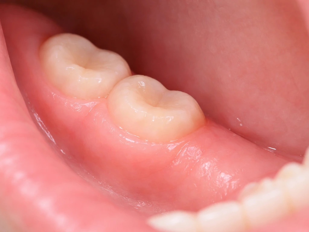 Close-up view of a healed wisdom tooth extraction gumline with subtle gumline difference