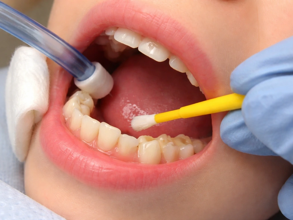 Closeup of fluoride varnish being applied with a small brush and tray on a child’s molars.