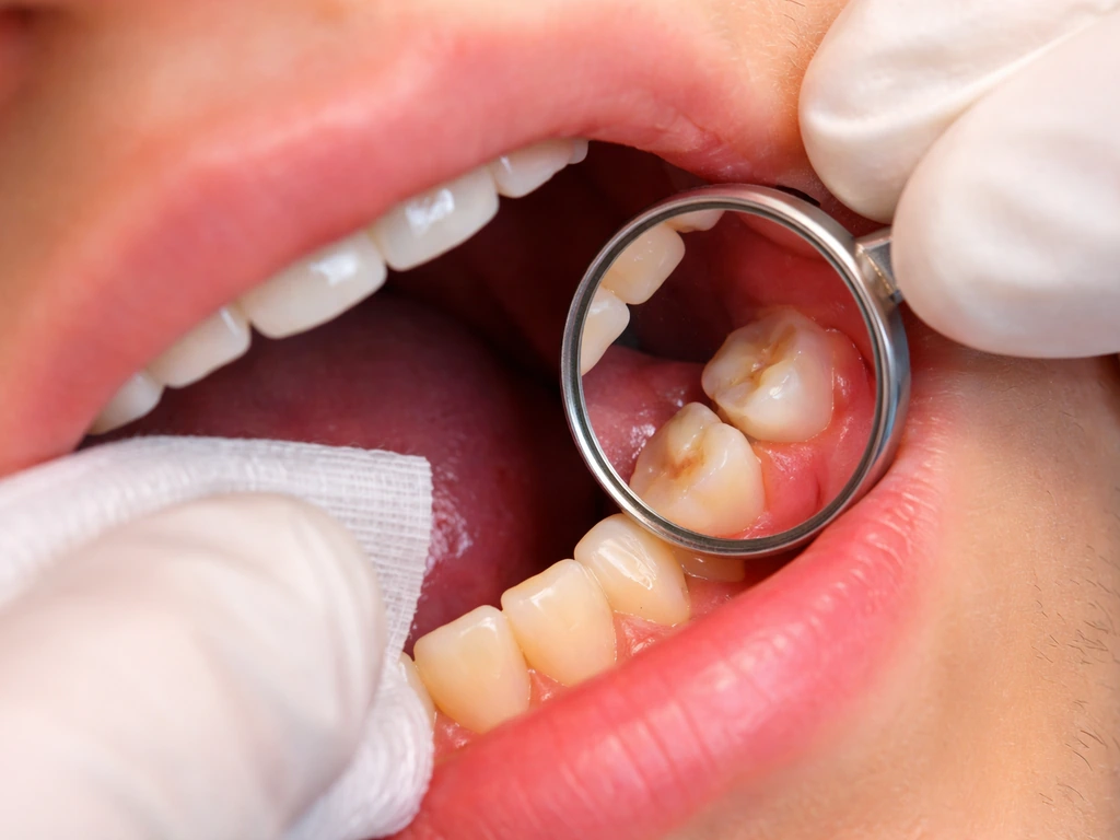 Side view showing a wisdom tooth erupting at an angle and being partially blocked.