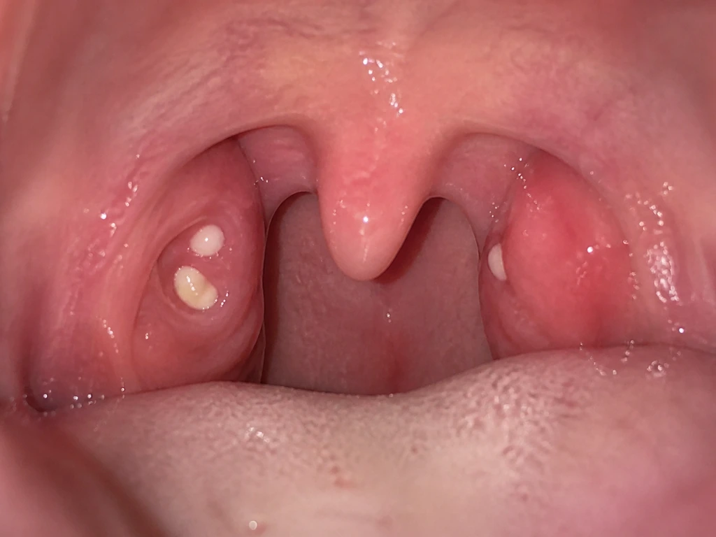 Can Tonsil Stones Grow Overnight? What to Do Now
