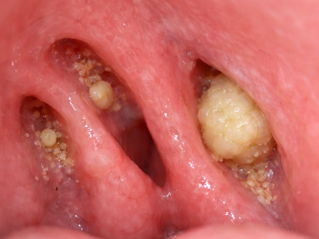 Close-up of tonsil crypts with small debris and pale tonsil stones forming in crevices.