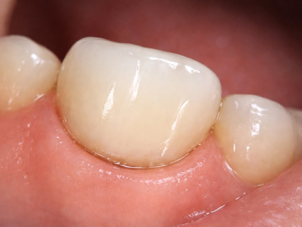 Clinical close-up of exposed crown margin at gumline with surrounding gum tissue in sharp focus