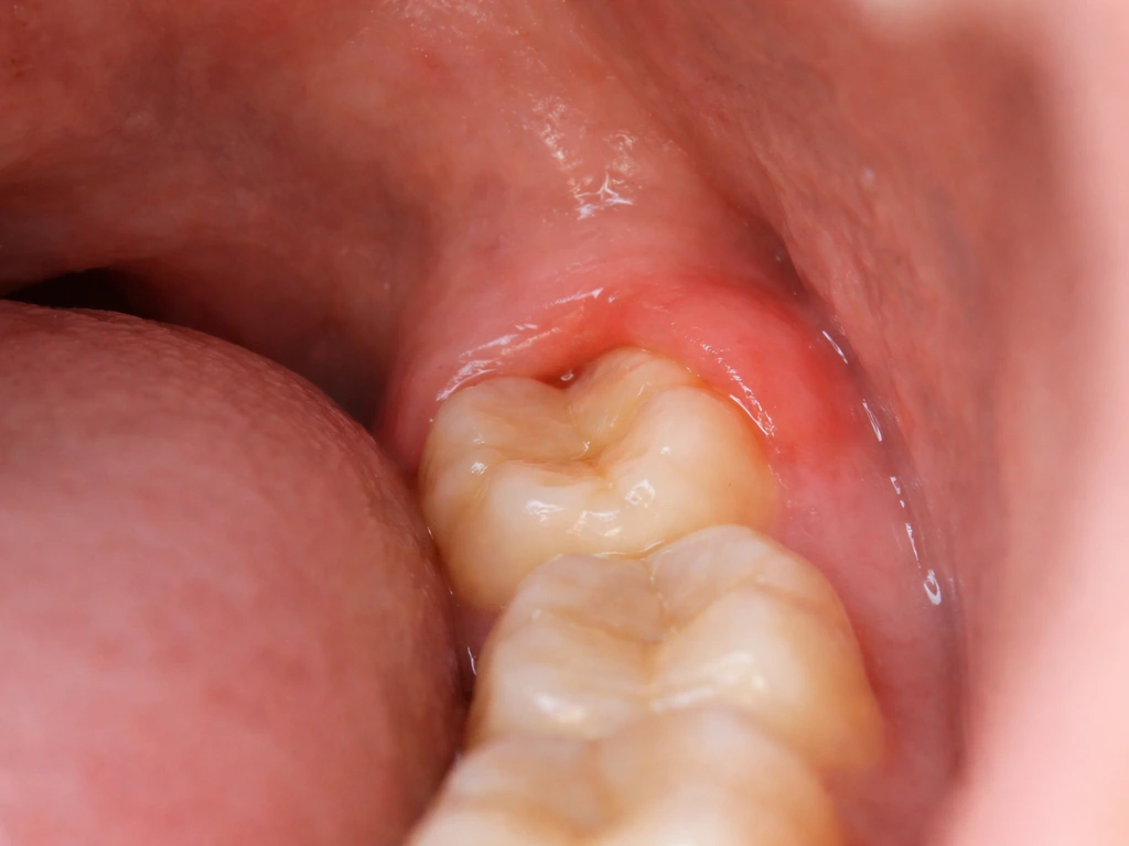 Close-up of back-of-mouth gum swelling around a partially erupted wisdom molar.