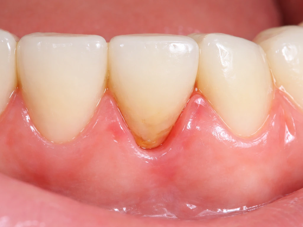 Close-up of receded gumline exposing a tooth root, showing gum recession from periodontal disease.