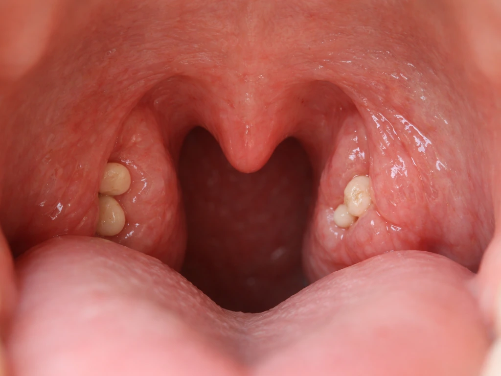 Close-up of tonsil tissue with small white pebble-like tonsil stones in the crevices.