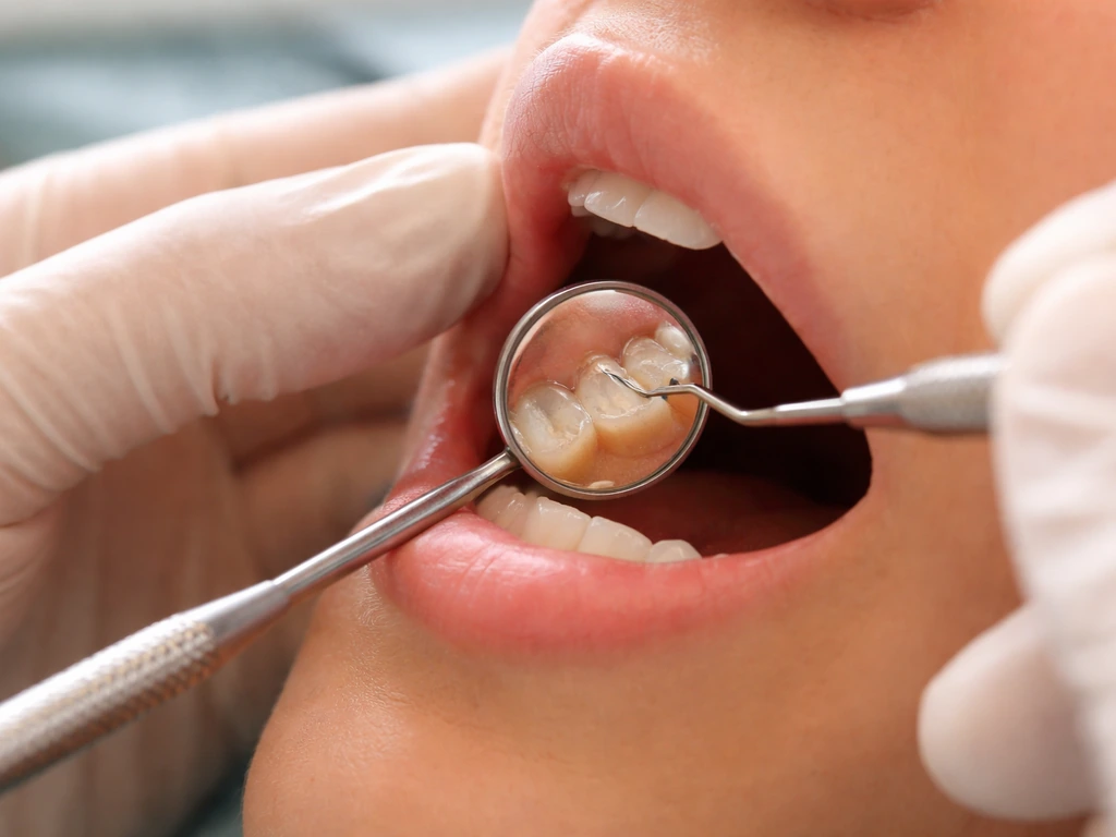 Dentist’s probe and mirror near a molar with a visible filling margin during an exam.