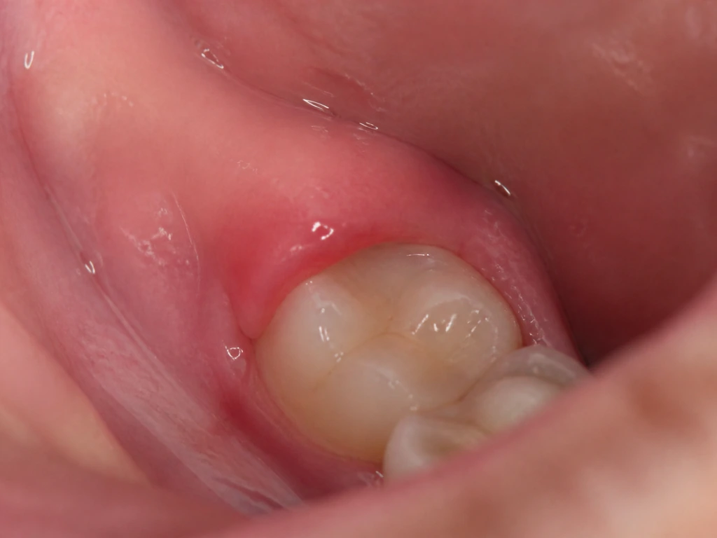 Close-up of an inflamed gum over a partially erupting molar, suggesting pericoronitis symptoms.