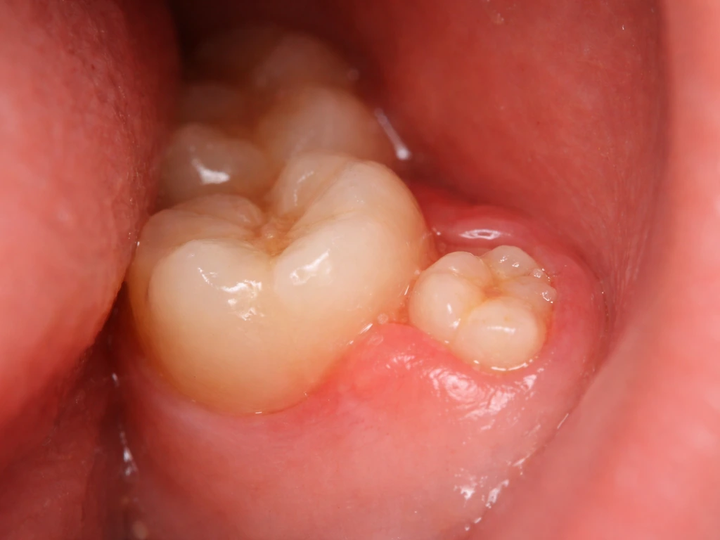 how to make wisdom teeth grow faster