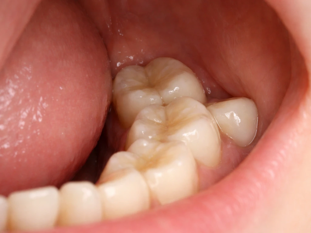 Close-up of an open mouth showing lower molars with crowding at the back from late wisdom tooth eruption