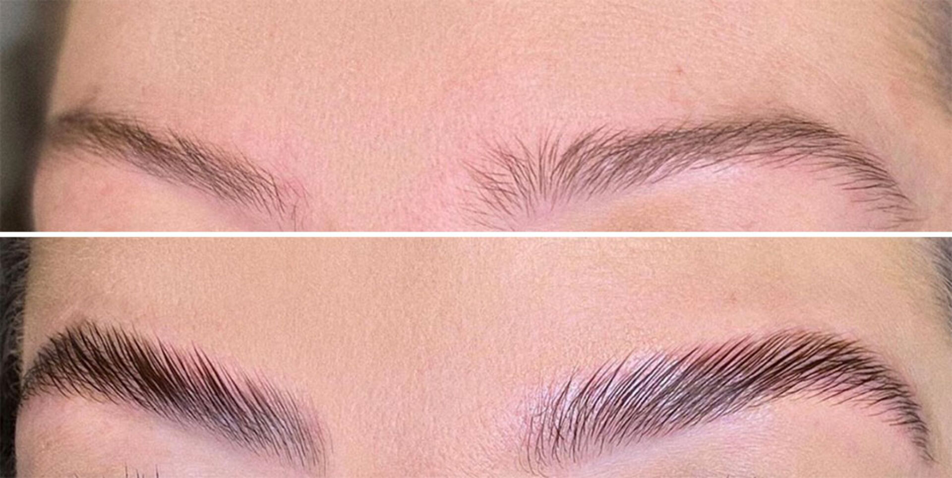 Brow Lifting Vorher - Nachher | Credit: Carmen Giuliani