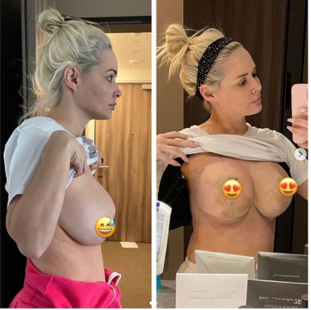 Daniela Katzenberger zeigt stolz ihren frisch gestrafften Busen.