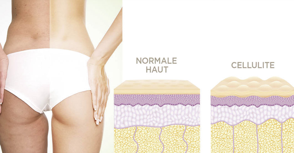 Eine bildliche Darstellung von Cellulite