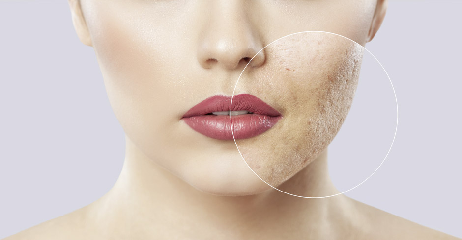 Eine grobporige Haut die gezeigt wird.