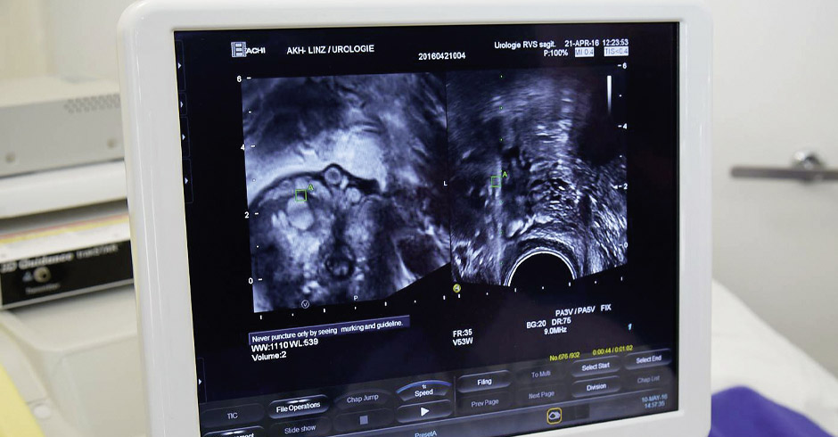 Ultraschalluntersuchung der Prostata