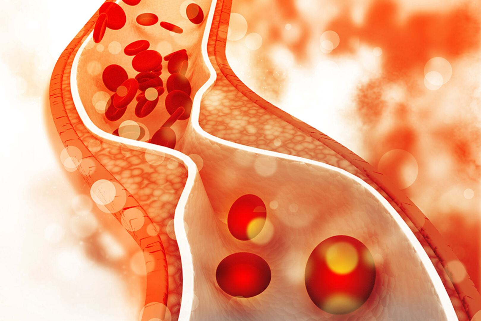 Cholesterin Plakette in Arterien | Credit: iStock.com/HYWARDS