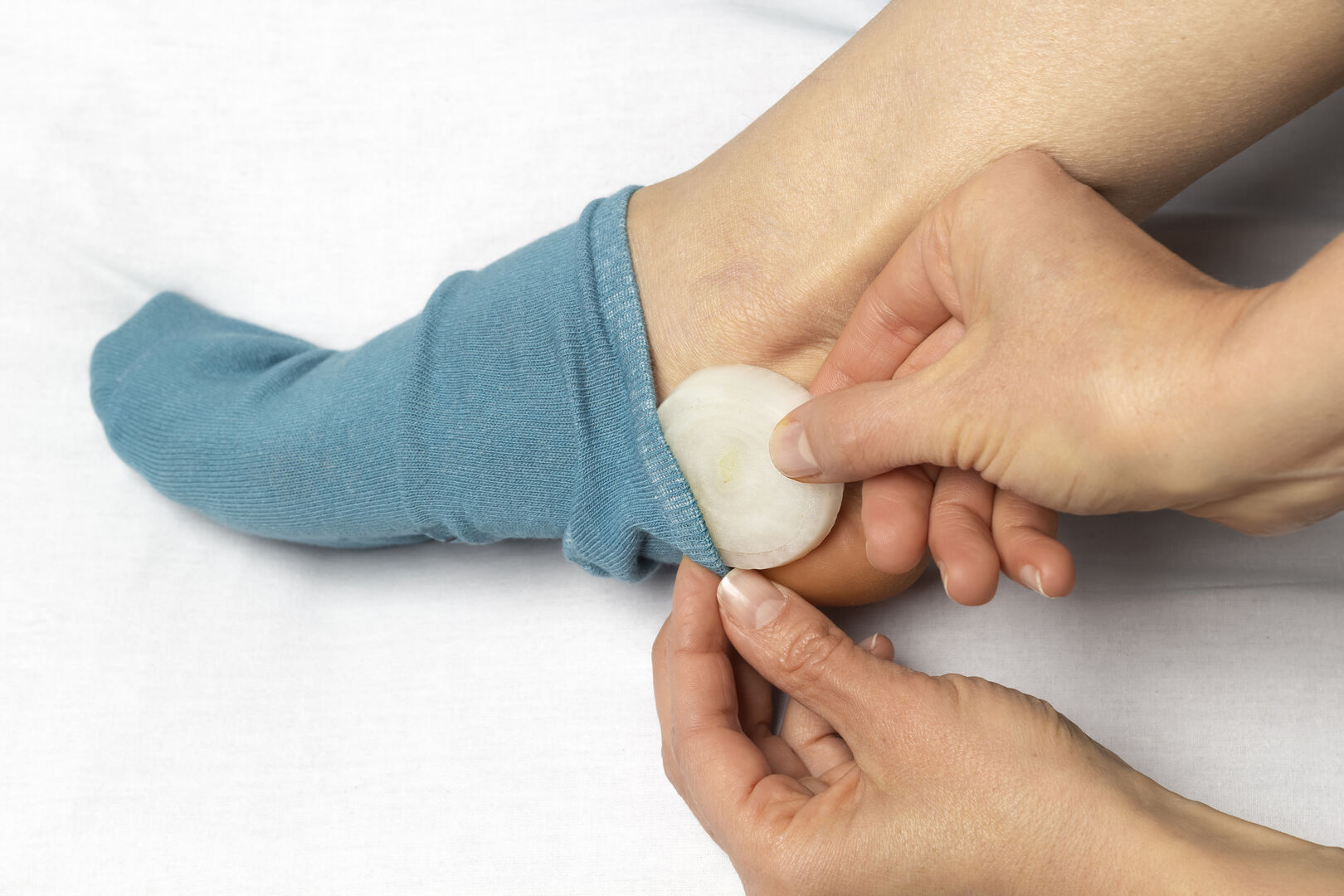 Zwiebel auf Mückenstich | Credit: iStock.com/Oleksandr Todorov