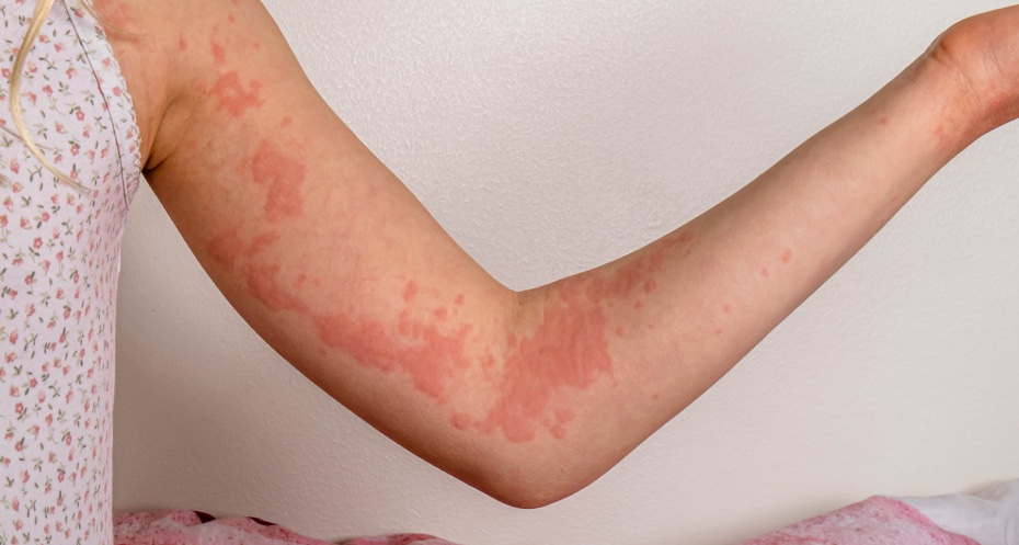 Allergische Reaktion: Pusteln auf der Haut am Arm. | Credit: iStock.com/Eik Scott