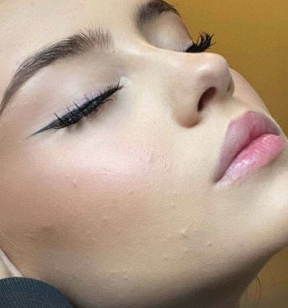 Eine Nahaufnahme aus der Story von Leni Klum, unter dem Makeup sind Pickel zu sehen.