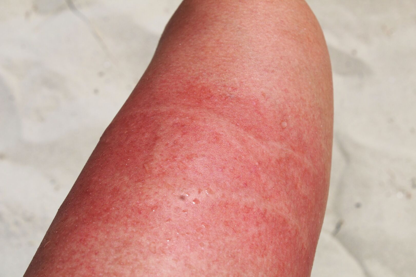 Verbrannte Haut auf einem Oberschenkel nach Kontakt mit einer Qualle