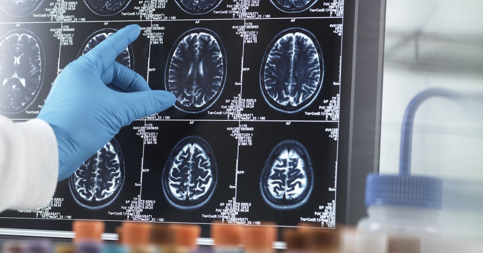 MRI-Bilder eines Gehirn.