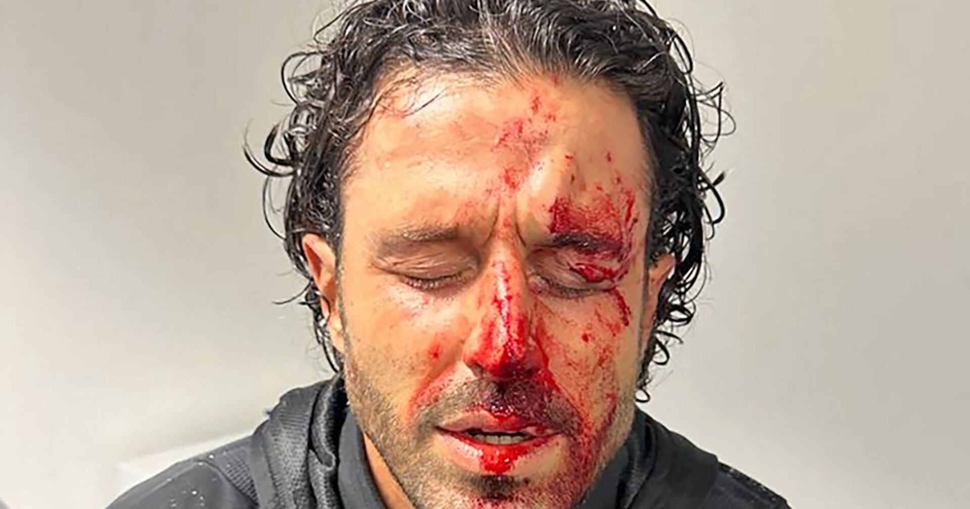 Nahaufnahme des blutverschmierten Gesichts von Fabio Grosso