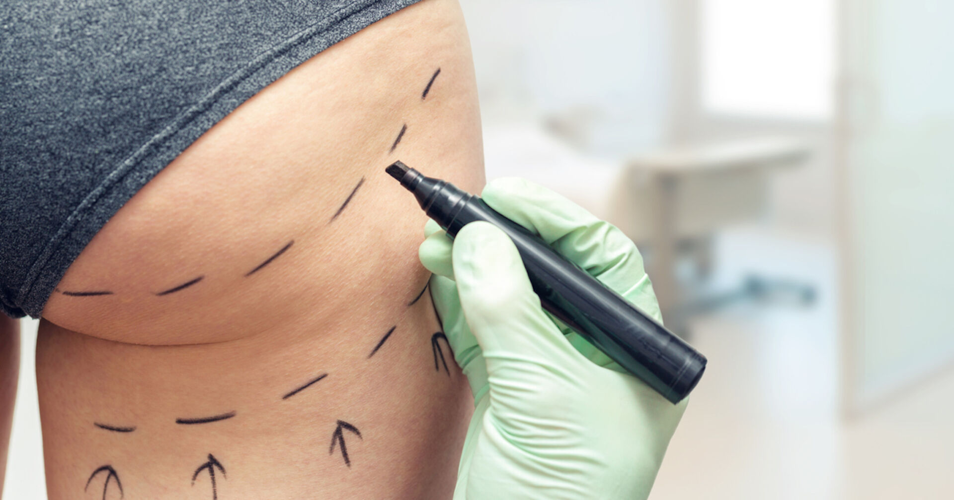 Ein Gesäß, das für eine Schönheitsoperation vorbereitet wird.