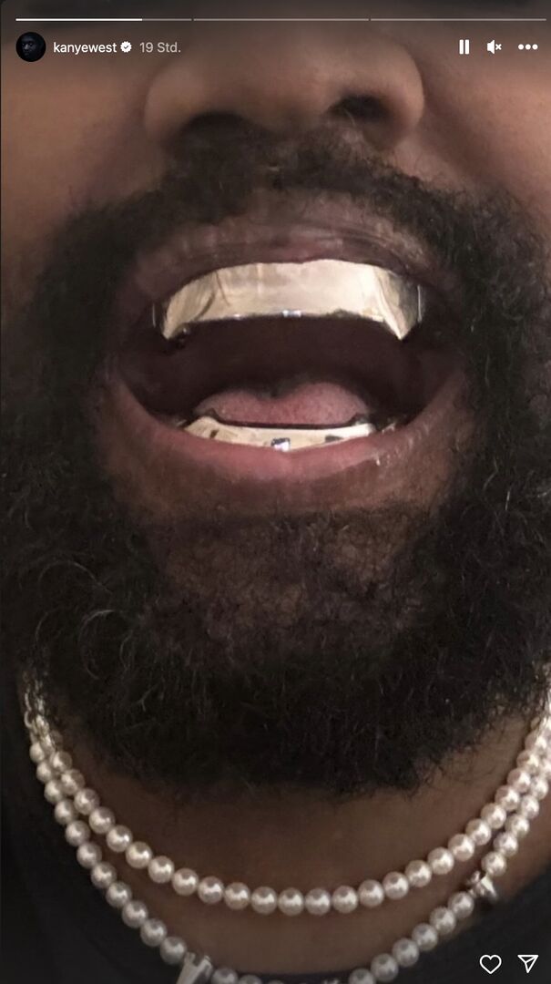 Kanye West zeigt auf einem Instagram Screenshot seine Titan-Zähne.