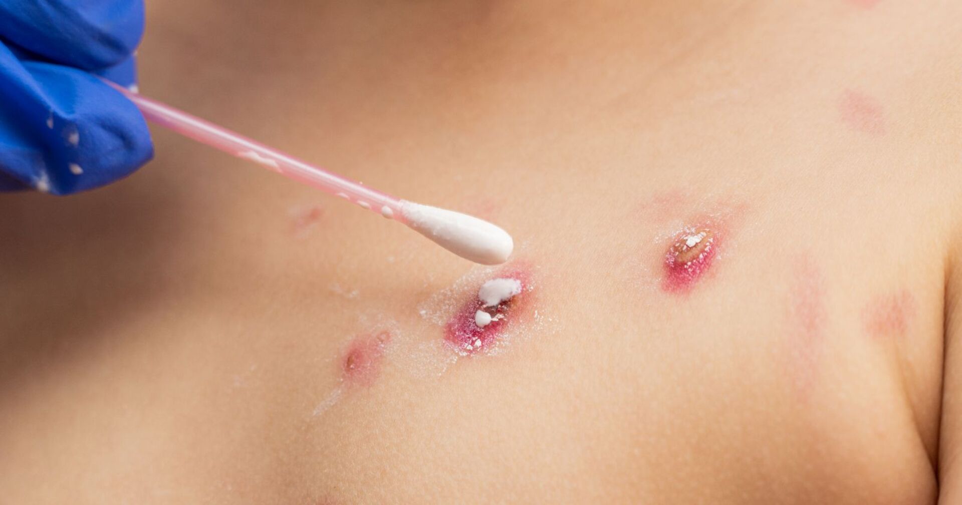 Bläschen auf der Haut werden mit einer Creme behandelt.