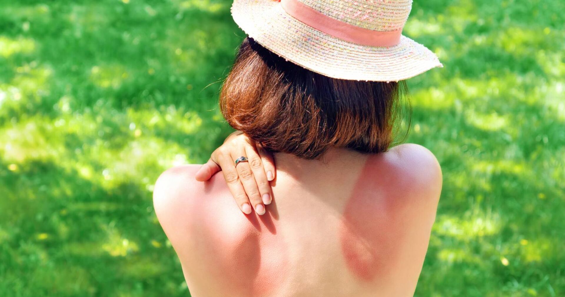 Frau mit entblößtem Rücken und Sonnenbrand