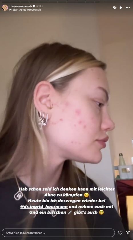 Cheyenne Ochsenknecht zeigt ihre Akne