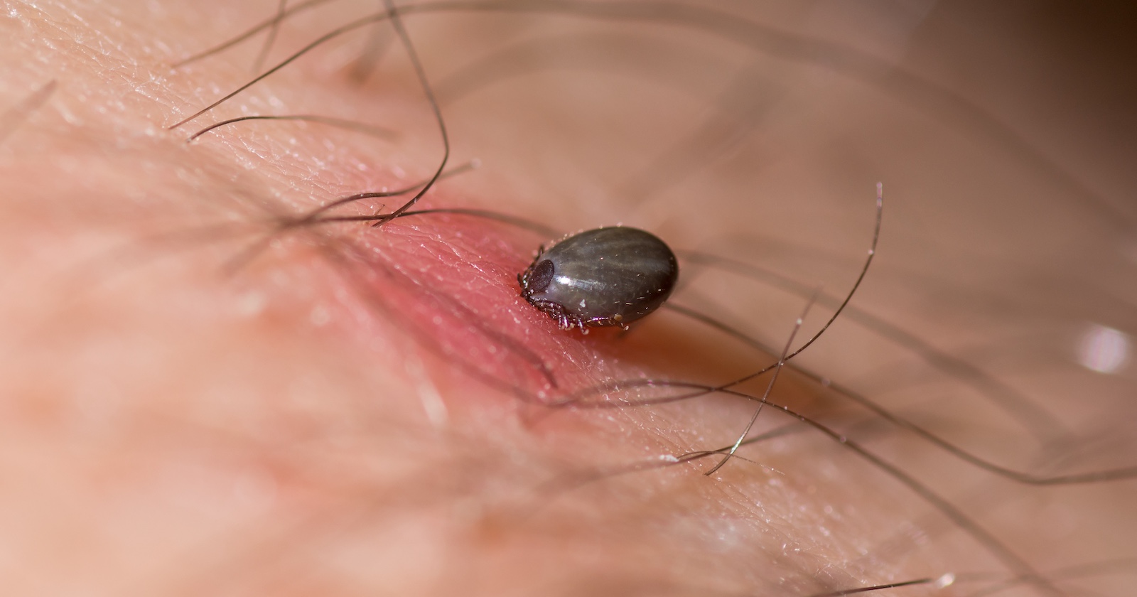 Ein Zecke, die in der Haut eines Menschen steckt.
