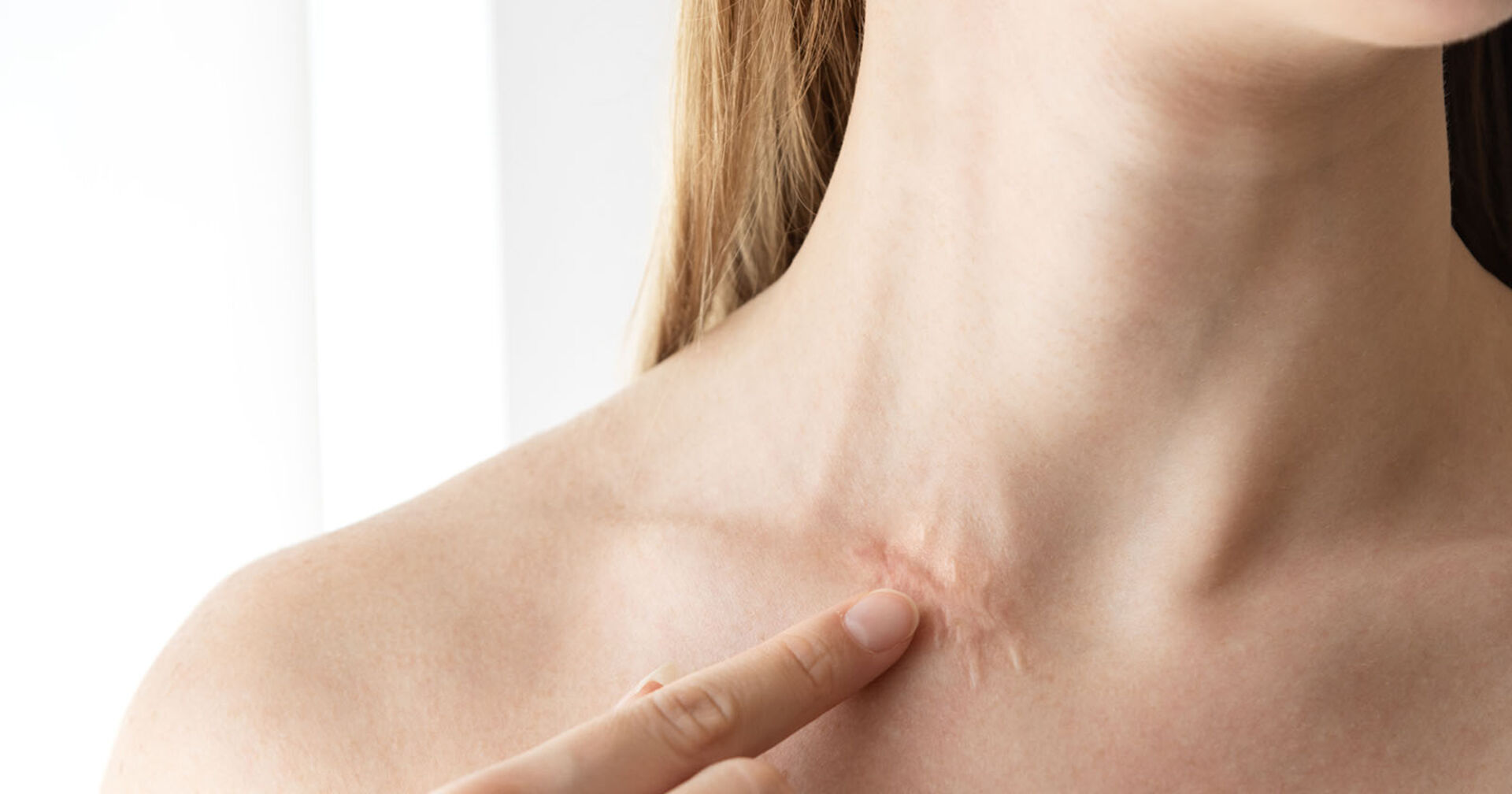 Frau hat Narbe am Hals | Credit: iStock.com/Anna Gorbacheva