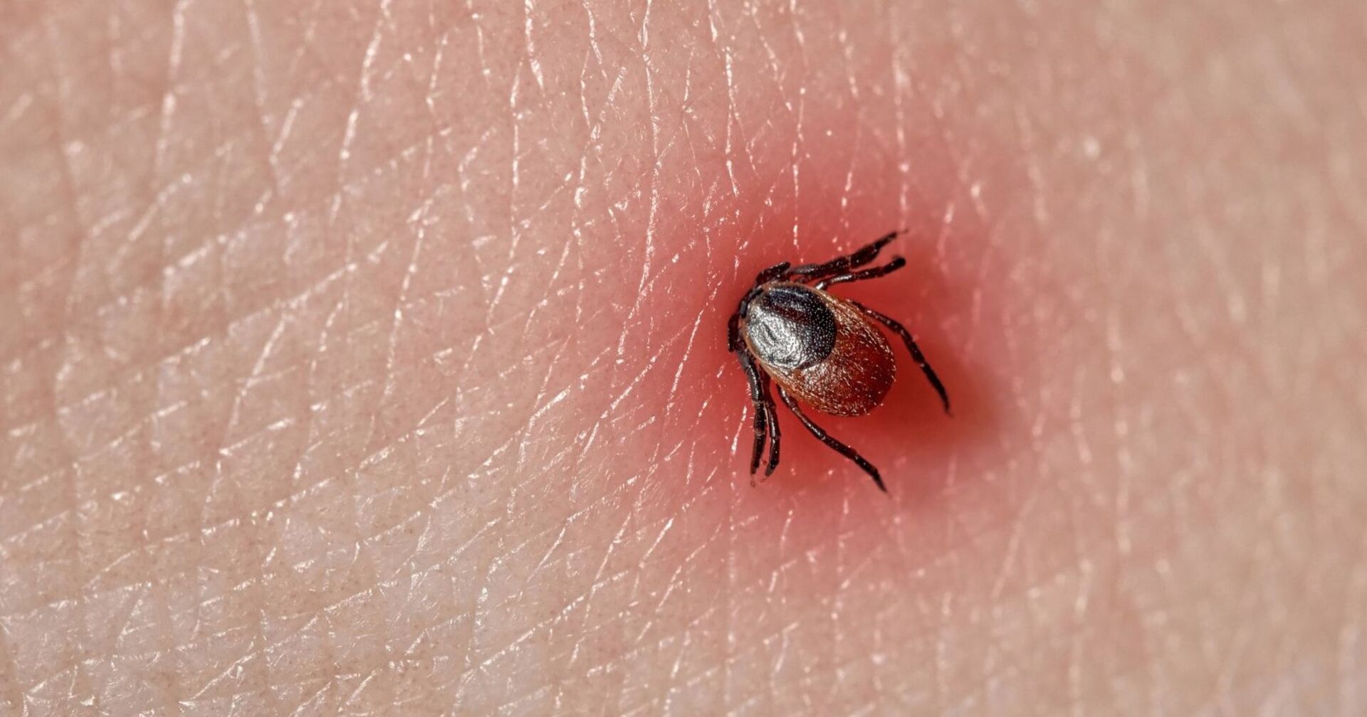 Nahaufnahme einer Zecke, die sich in geröteter menschlicher Haut festgesetzt hat – mögliche Übertragungsquelle für Lyme-Borreliose.