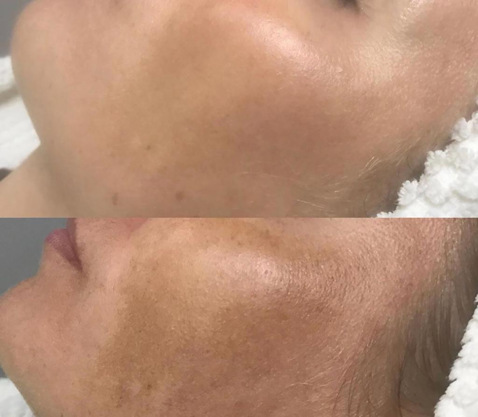Wangen einer Frau vor und nach einer Hydrofacial Behandlung | Credit: Individual Beauty