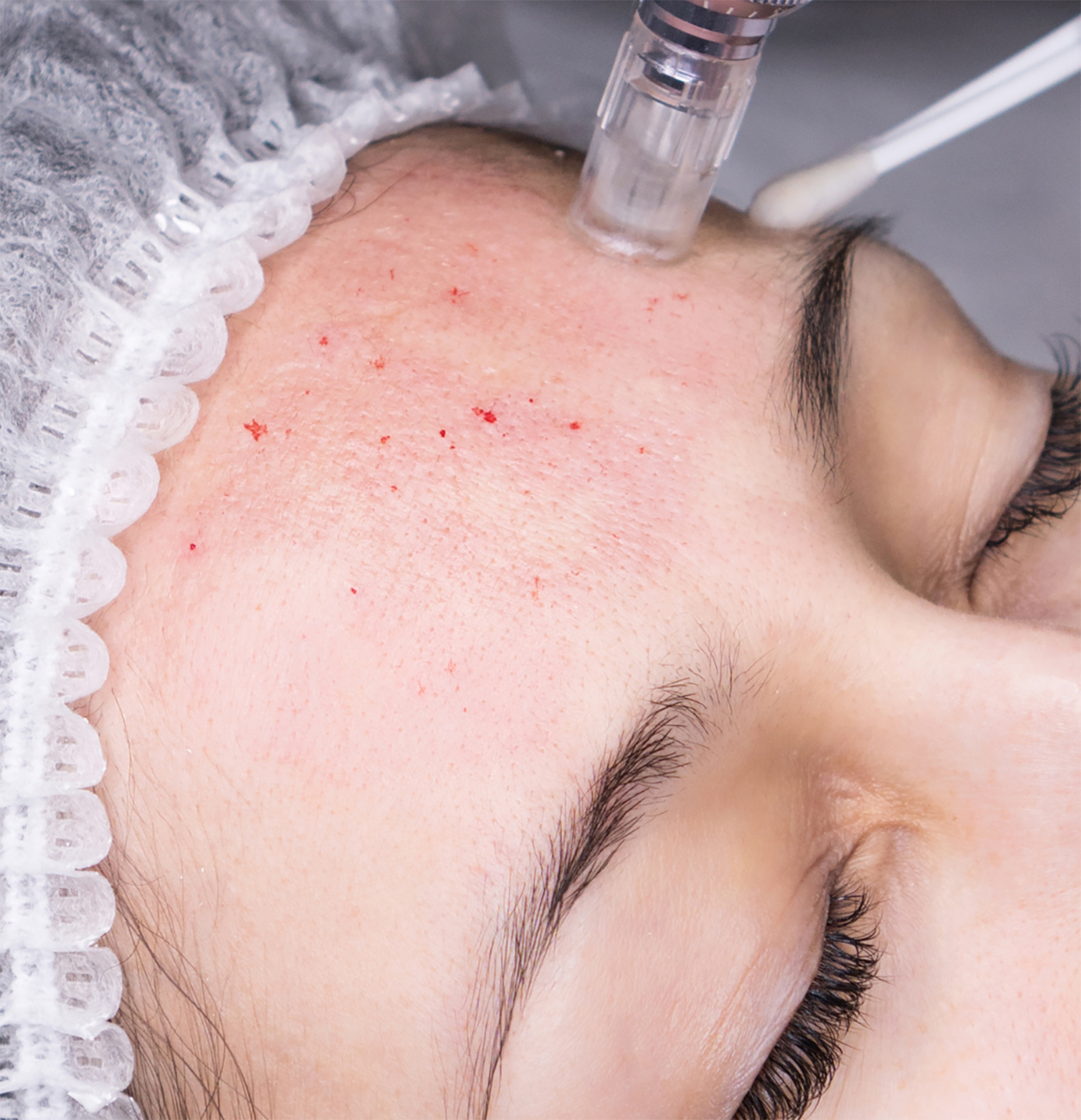 Frau bei einer Microneedling-Behandlung | Credit: Individual Beauty